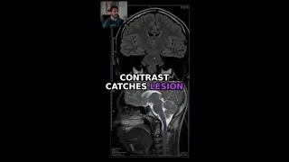 Thumbnail: This Brain MRI Looks Normal… Or Does It? 🧠
