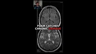 Thumbnail: FLAIR MRI: The Most Important Sequence After DWI