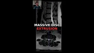 Thumbnail: Massive Disc Extrusion on MRI 😱 #Shorts