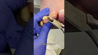 Thumbnail: The Shocking Truth Behind This Foot Infection