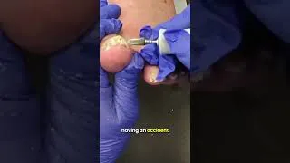 Thumbnail: The Final Step: Cleaning Out a Deep Foot Infection