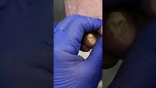 Thumbnail: Watch This Thick Toenail Removal #satisfying #podiatry #shorts