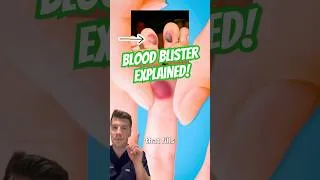 Thumbnail: What is a blood blister? Doctor fact check! #shorts