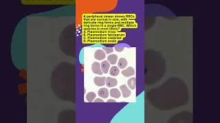 Thumbnail: Plasmodium falciparum Malaria 🔥 | NEET PG 2026 High-Yield Points | #mbbs #neetpg  #shorts #viral