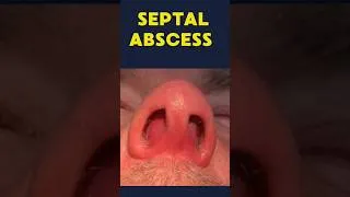 Thumbnail: septal abscess / medical short note #ent