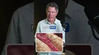 Thumbnail: The Real Cause of Clogged Arteries