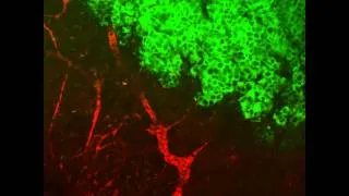 Thumbnail: Tumor Cells in Motion