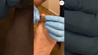 Thumbnail: Transform your toenails from 😷 to 😍! Say goodbye to discoloration and thickening caused by toenail