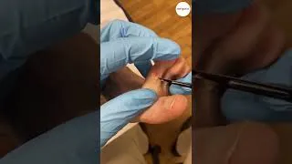 Thumbnail: Ouch! 🌽✨ Struggling with corn between your toes? Let's find a cure together! 🚶‍♂️👣 Don't let the