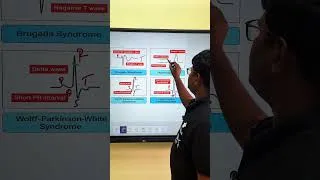 Thumbnail: ECG /episodes 5 #shorts #viralshorts #nursingeducation
