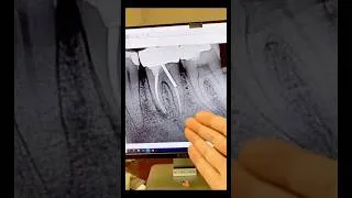 Thumbnail: No cbct! #dentists #apexdental #rootcanaltherapy #dentalartistry #dentalcare