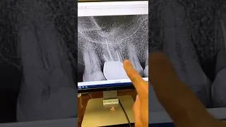 Thumbnail: No cbct! #dentists #apexdental #rootcanaltherapy #dentalartistry #dentalcare