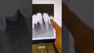 Thumbnail: No cbct! #dentists #rootcanaltherapy #apexdental #dentalartistry #dentalcare