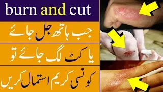 Thumbnail: best cream for fungal infections cut and burn || antifungal medications || hydroxychloroquine