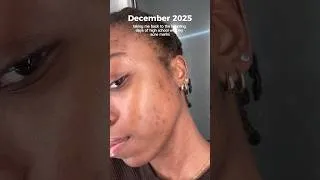 Thumbnail: adult acne suckss 🙂‍↕️ so I’m starting tretinoin #skincare #tretinoinjourney #hyperpigmentation
