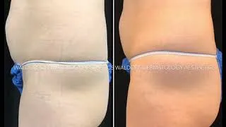 Thumbnail: EMSculpt: Real Patient Results by Dr. Heidi Waldorf