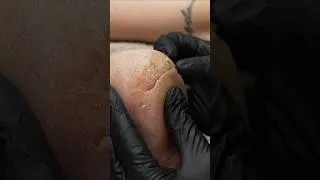 Thumbnail: How I Fixed The Deepest Cracked Heel
