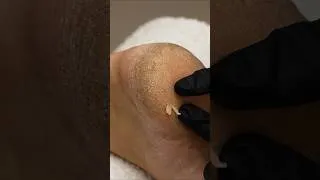 Thumbnail: How I Solved Severely Cracked Heels