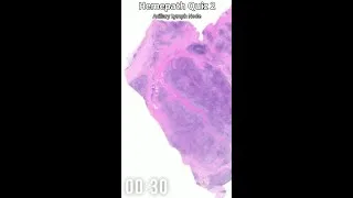 Thumbnail: Hemepath Quiz #2 - Axillary Lymph Node