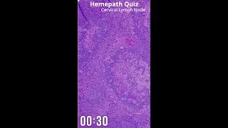 Thumbnail: Hemepath Quiz #1 - Cervical Lymph Node