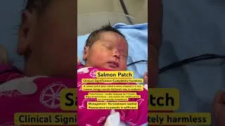 Thumbnail: Salmon Patch #baby #cute #cutebaby #dothingsyoudontwanttodo #newborn