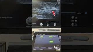 Thumbnail: 74 || Penile Mondor's Disease || Ultrasound || Imaging Study