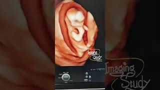 Thumbnail: 73 || Dancing Fetus 3D || Imaging Study