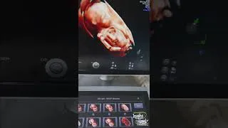 Thumbnail: 71 || Fetus 3D || Ultrasound Tutorial | Imaging Study
