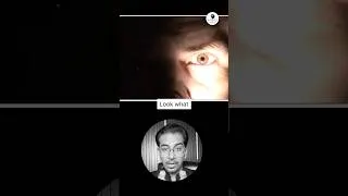 Thumbnail: Can You Spot the Problem in Right Eye? #neurology #medicine