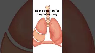 Thumbnail: Medical coder your should this Root operation Resection