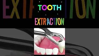 Thumbnail: Root operation- Extraction # ip drg#HCC # pcs coding
