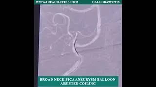 Thumbnail: Broad Neck PICA Aneurysm Balloon Assisted Coiling | IRFACILITIES