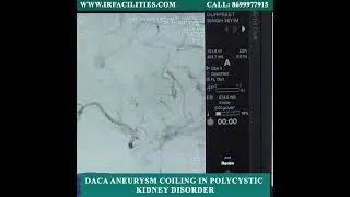 Thumbnail: DACA Aneurysm Coiling in Polycystic Kidney Disorder