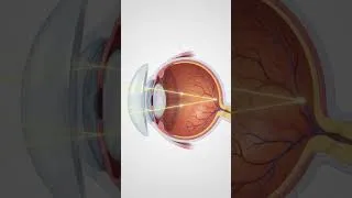 Thumbnail: #physics #optics #retina #human #eye #convex #lens #farsightedness #hypermetropia #defect#correction