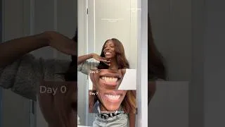 Thumbnail: Counting down to forever with a camera ready smile using @Crest 3DWhitestrips Professional Results