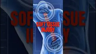 Thumbnail: “Soft Tissue” Doesn’t Mean a Minor Injury #personalinjury