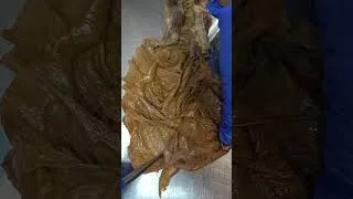 Thumbnail: Interior of Caecum & Appendix (Part 1) | Cadaveric Anatomy | MBBS Anatomy Made Easy
