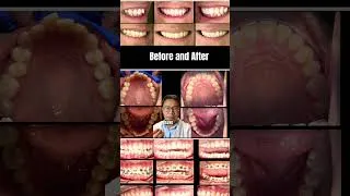 Thumbnail: Three reasons why you ought to get braces