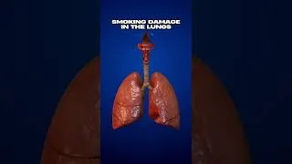 Thumbnail: Smoking Damage in the Lungs 🚬