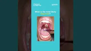 Thumbnail: A child with fever, sore throat and dysphagia has the lesion shown below. What is the diagnosis?