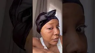 Thumbnail: Hair dye gone wrong #dyeallergy #hairdyegonewrong #pixiecut