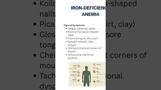 Thumbnail: NCLEX Review: Iron-Deficiency Anemia #medsurgnursing #nursingschool #irondeficiencyanemia