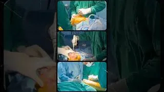 Thumbnail: Trust your vision..!! #doctors #doctors #mbbs #trending #surgery #operationtheatre #orthopedics