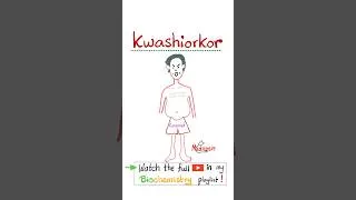 Thumbnail: Kwashiorkor - Protein Energy Malnutrition - Gastroenterology...#diet #nutrition #food #vitamins