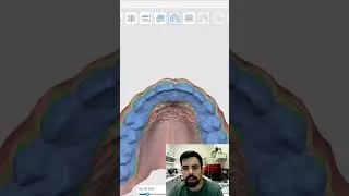 Thumbnail: Medit Splint design