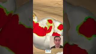 Thumbnail: Simple workflow of inlay design with Medit ClinicCAD