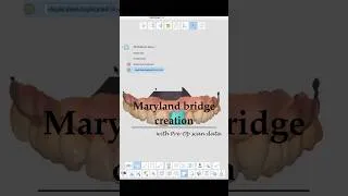 Thumbnail: Maryland bridge creation with pre-op scan data