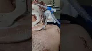 Thumbnail: Air Leak From the Lung | Pneumothorax in real case