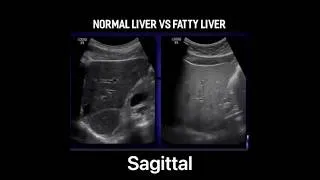 Thumbnail: Fatty Liver on Ultrasound