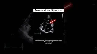 Thumbnail: Severe Mitral Stenosis on Echo